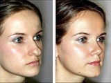 تجميل الانفRhinoplasty