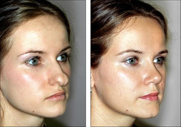 تجميل الانفRhinoplasty