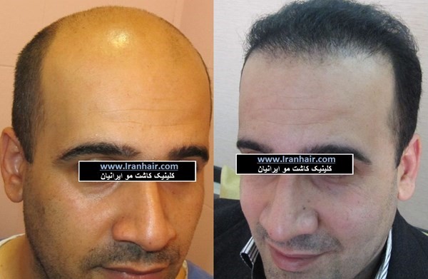 زراعة الشعر و اللحية و الحاجب في طهران